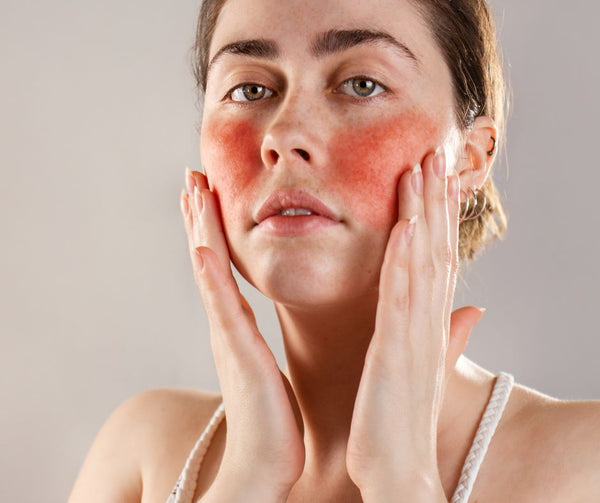 Understanding Rosacea: A Compassionate Guide to Living with the Condition
